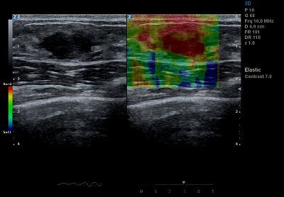 Breast Elastic Imaging(001)