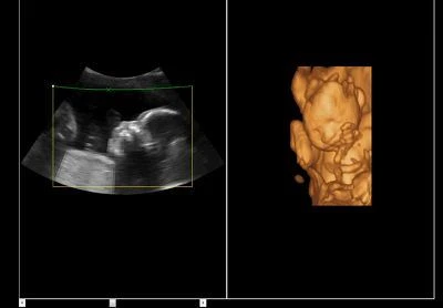 Fetal Face